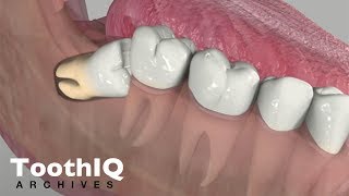 Impacted Tooth Removal [upl. by Orual]