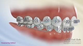 Elastics  Class II Triangle 3 to 46  Orthodontic Treatment [upl. by Busey]