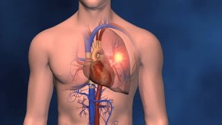 Embolism Pulmonar y TVP [upl. by Aserahs]