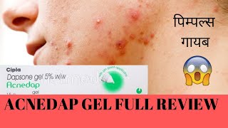 ACNEDAP GEL FULL REVIEW BEST FOR ACNE AND PIMPLE [upl. by Attenweiler]