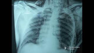 Subcutaneous Emphysema Chest X Ray [upl. by Esikram]