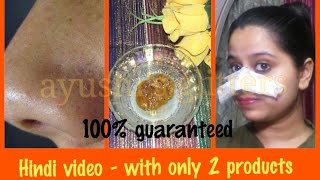 ब्लैक हेड्स हमेशा के लिए हटाने का सबसे अच्छा तरीका  BEST WAY TO REMOVE BLACKHEADS PERMANENTLY [upl. by Lerad369]