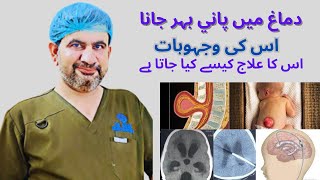 Hydrocephalus in urdu hindhiSymptomscuaseDiagnosisTreatmentPreventionPrognosis [upl. by Porter]