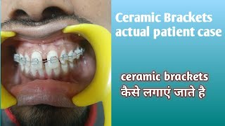 Ceramic Braces actual patient case [upl. by Linson573]