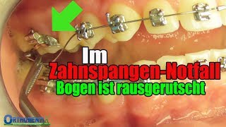 Im ZahnspangenNotfall Bogen ist RAUS feste Zahnspange Kieferorthopäde  Orthodentix [upl. by Lieno277]