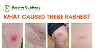 Rash Identification from Bites Stings and Rashes in the Outdoors [upl. by Ahsitak]