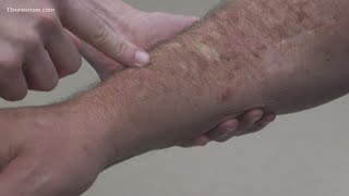 Skin Cancer How to spot melanoma warning signs [upl. by Nilek]