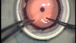 Endothelial keratoplasty by DrSamar Kumar Basak  Disha Eye Hospitals [upl. by Yrebmik19]