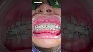 Dental Braces Adjustment  Ceramic Dental Braces Workflow  bracesadjustment dentalbraces braces [upl. by Meir]