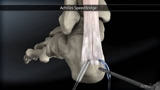 Tendinite insertion Achille et Haglund [upl. by Elcarim]