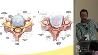 Management of Cervical Stenosis  Charles A Sansur MD [upl. by Alledi]