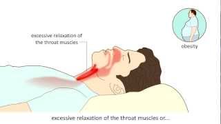 Obstructive Sleep Apnea Syndrome OSAS  Causes and treatment [upl. by Bbor]