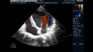 Insuficiencia valvular Aortica  Mitral y Tricuspidea leve Nov 2010 [upl. by Danette]