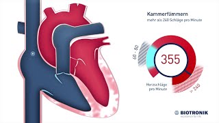 Kammerflimmern amp plötzlicher Herztod Animation [upl. by Yesnil]