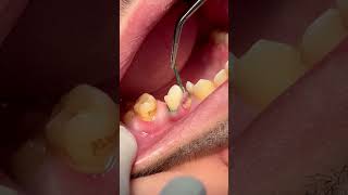 Removing retraction cord after tooth RCT amp composite restoration [upl. by Shakti139]