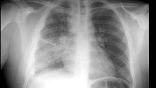 Miliary Tb on X ray [upl. by Arreyt801]