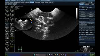 5582 SINITIS NASAL SINUS ULTRASOUND BONE LYSIS ECHOPAC ANALYSIS [upl. by Eittod888]