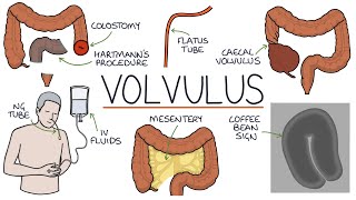 Understanding Volvulus Twisted Bowel [upl. by Ecilef545]