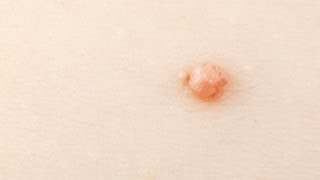 Skin Tags  How To Get Rid Of Them What Causes Them What Are They [upl. by Nata]