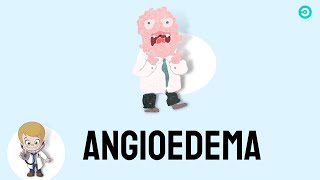 Angioedema signs amp symptoms causes and treatment [upl. by Elletnwahs]