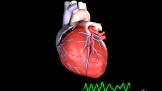 What is Ventricular Fibrillation [upl. by Haraj]