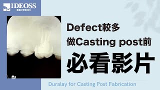 Duralay for Casting Post Fabrication︱defect較多牙齒條件不好的釘柱製作示範︱Post蠟型 [upl. by Acirretahs]