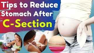 Tips to Reduce Stomach After C Section  How to lose belly Fat After Pregnancy [upl. by Nnyledam]