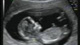 11w 5d ultrasound [upl. by Veno]