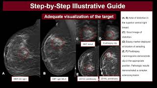 Prone Tomosynthesisguided Breast Biopsy A Primer DR LAMIAA [upl. by Lavine]