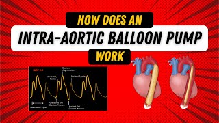 How Does an Intra Aortic Balloon Pump Work Guide for Nurses [upl. by Yerdua]