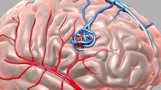 Arteriovenous Malformation AVM [upl. by Anchie]