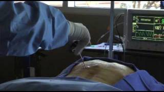 Osteoporosis Pain Watch this Vertebroplasty Procedure  Live [upl. by Orabla]