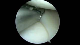 Meniscal Capsular Junction Novostitch Plus Repair [upl. by Meyer]