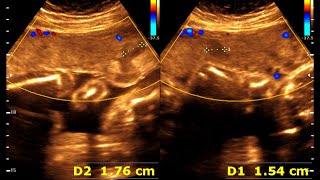 25 weeks 0 days pregnancy  Normal pregnancy  Placental lake [upl. by Schlessinger]