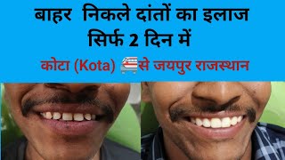 बाहर निकले दांतों का इलाज सिर्फ 2 दिन में Smile design treatmentKota कोटा से जयपुर Rajasthan [upl. by Pavlov216]