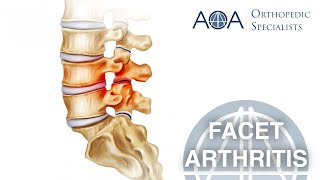 AOA Orthopedic Specialists  Facet Arthritis [upl. by Neu]