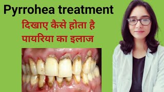 Pyrrohea treatmentपायरिया का इलाजपायरिया का इलाज कैसे होता हैमसूड़ों के बीमारी कैसे ठीक करे [upl. by Rattray731]