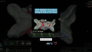 AFib Ablation Procedure Using 3D Map of Heart [upl. by Leopoldeen304]