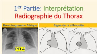 Interprétation Téléthorax N°01 Radiographie du Thorax Syndrome Alvéolaire Pneumologie imagerie PFLA [upl. by Ary645]