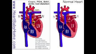 44 Coarctation of the Aorta bicuspid aortic aortic root dilation [upl. by Airrotal]