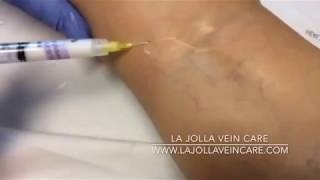 A Sclera Spider Vein Treatment at La Jolla Vein and Vascular Vein Care [upl. by Valsimot543]