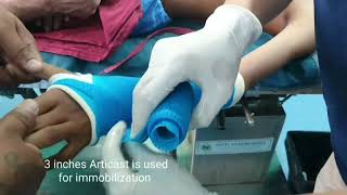 Wrist fractures in kids  Epiphyseal injury  Closed reduction fractures Fiberglass  Adamya H Vid [upl. by Raknahs144]