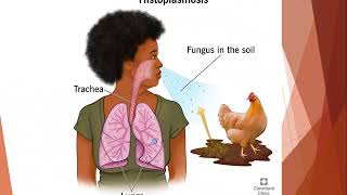 HISTOPLASMOSIS  SYSTEMIC MYCOSIS  MBBS Pathology and Microbiology Lectures [upl. by Leibman10]