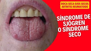 BOCA SECA OJOS SECOS ARTRITIS  Síndrome de Sjögren [upl. by Suk]