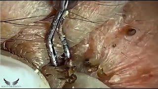 Elderly Hidden Blackhead Removal  Cystic Acne Treatment  Pimple Popping Spa  Acne on Face  079 [upl. by Nojram434]