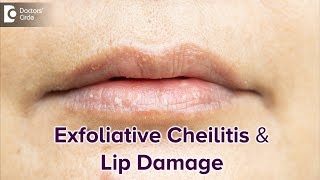 Exfoliative Cheilitis amp its effect on Lips  DRY LIPSBest TreatmentDrRasya Dixit Doctors Circle [upl. by Sutniuq]