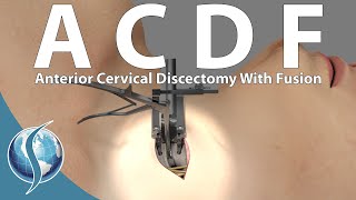 Anterior Cervical Discectomy and Fusion [upl. by Esenej]