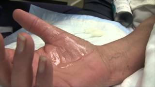 Trigger Finger Injection Therapy [upl. by Cotter]