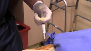 Live Intraarticular Hip Injection with a Hip Replacement [upl. by Enilarac223]