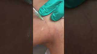 Sclerotherapy for Spider Veins [upl. by Graybill]